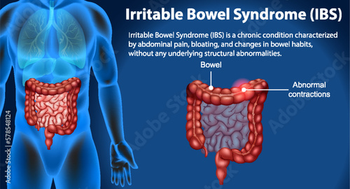 Irritable Bowel Syndrome (IBS) Infographic