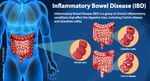 Inflammatory Bowel Disease (IBD) Infographic
