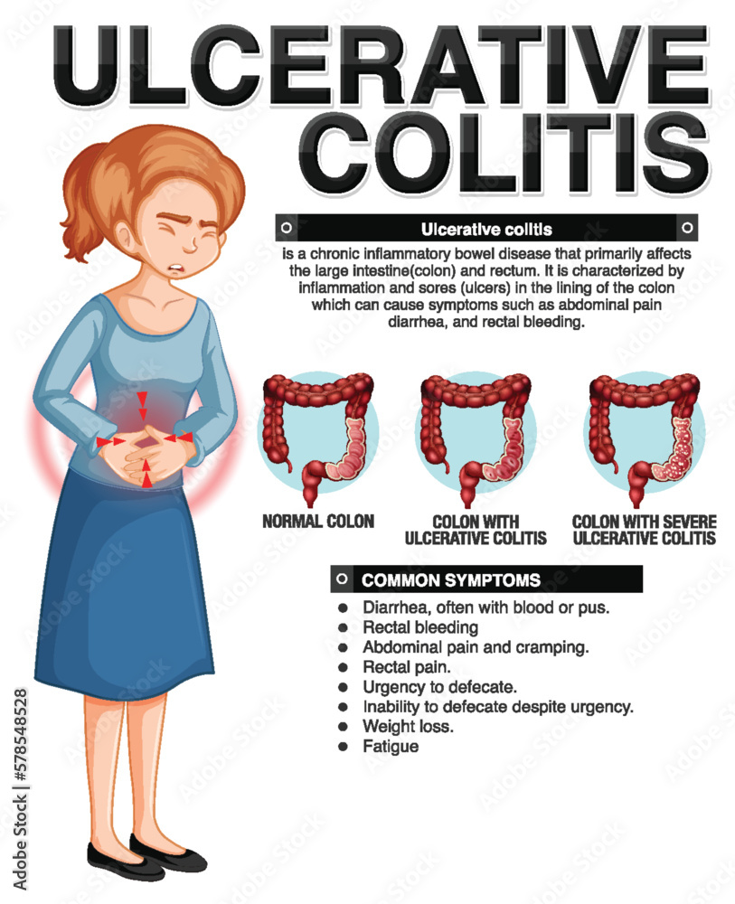 ulcerative-colitis-symptoms-infographic-stock-vector-adobe-stock