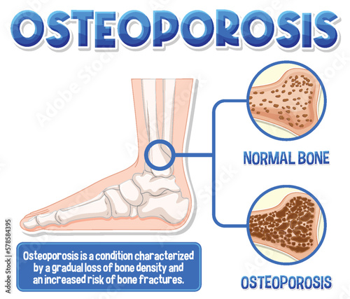 Informative poster of Osteoporosis human bone