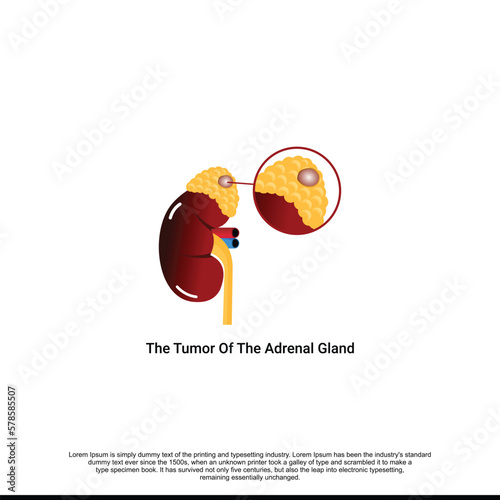 A tumor of the adrenal gland. Structure of the kidneys. Vector illustration on isolated background