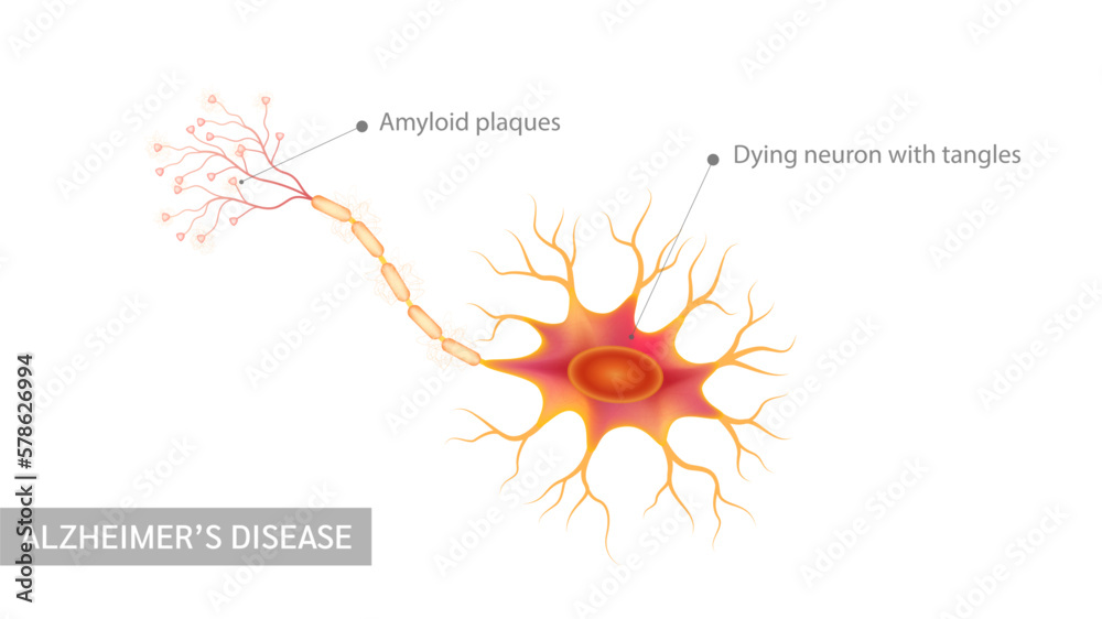 Alzheimer's disease. Dying neuron with tangles and Amyloid plaques