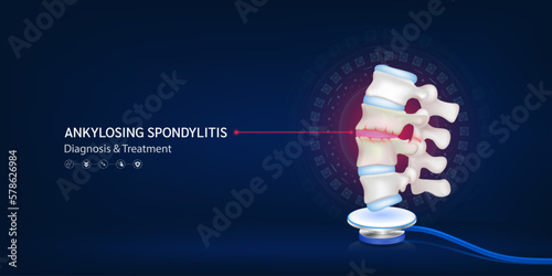 Ankylosing spondylitis, Human spine disc cartilage model float away from stethoscope. Doctor diagnosis treatment. Medical technology innovation concept. Banner design for pharmacy clinic. 3d Vector