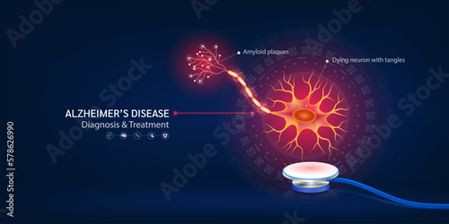 Alzheimer's disease. Human nerve model float away from stethoscope. Dying neuron with tangles and Amyloid plaques. Doctor diagnosis treatment. Banner design for pharmacy clinic. 3d Vector.