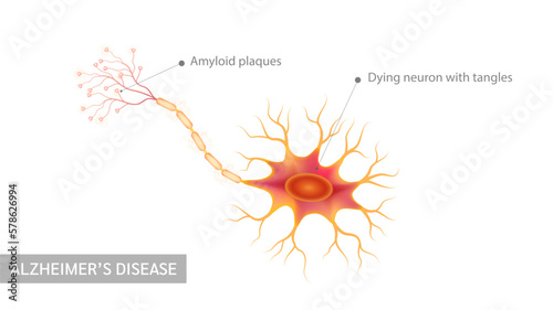 Alzheimer's disease. Dying neuron with tangles and Amyloid plaques. Neural net structure cell anatomy model isolated on white background. Medicine and science concept. 3D Vector.