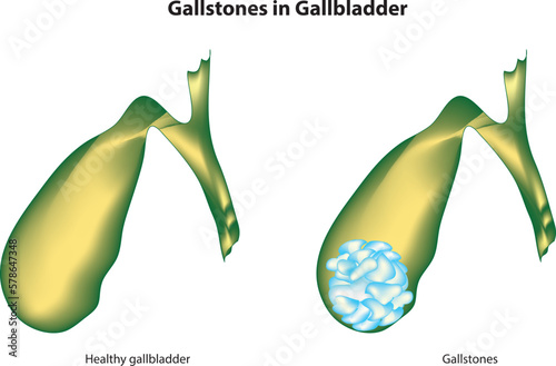 Gallstones ( small stones, usually made of cholesterol, that form in the gallbladder)