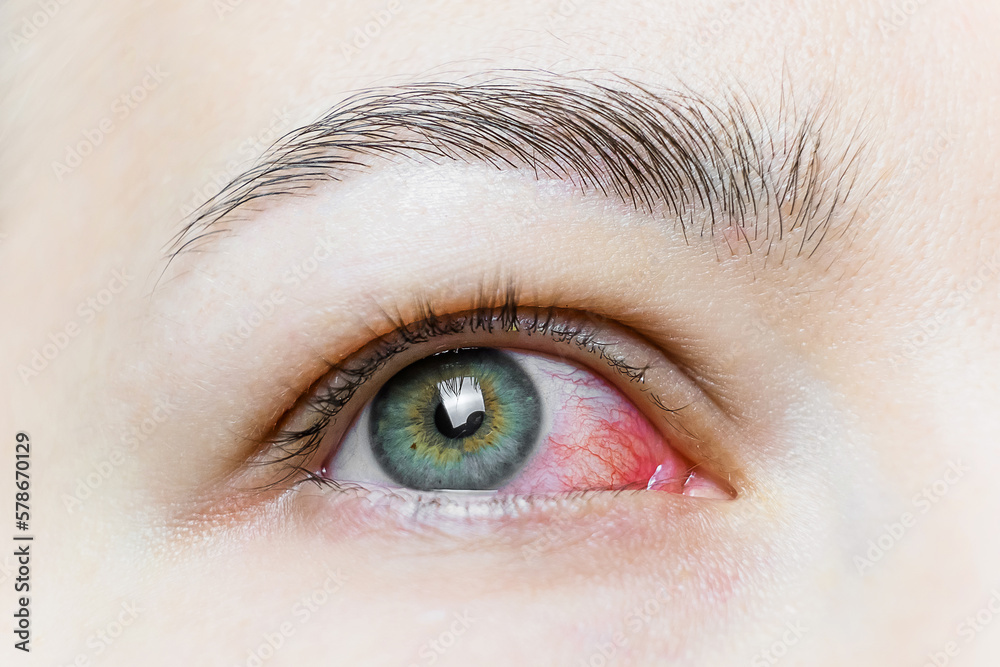 Obraz premium Close up of a severe bloodshot red eye. Viral Blepharitis, Conjunctivitis, Adenoviruses. Irritated or infected eye.