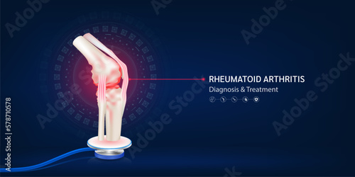 Rheumatoid arthritis, Human bone joint red cartilage model float away from stethoscope. Doctor diagnosis treatment. Medical technology innovation concept. Banner design for pharmacy clinic. 3d Vector.