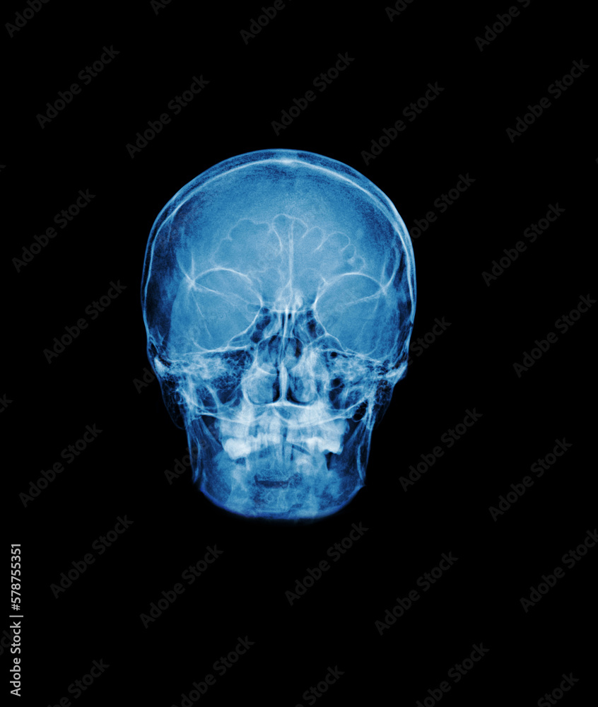 Film x-ray Skull AP show normal human's skull Film x-ray Skull AP show normal human's skull