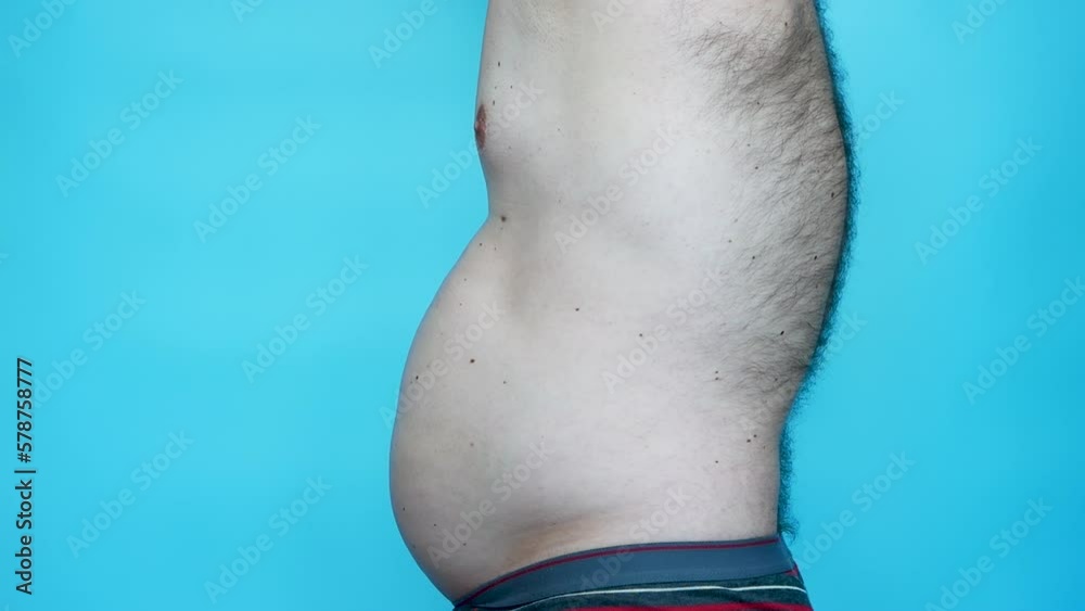 Scoliosis of the spine. A man with curvature of the spine. Torso of a