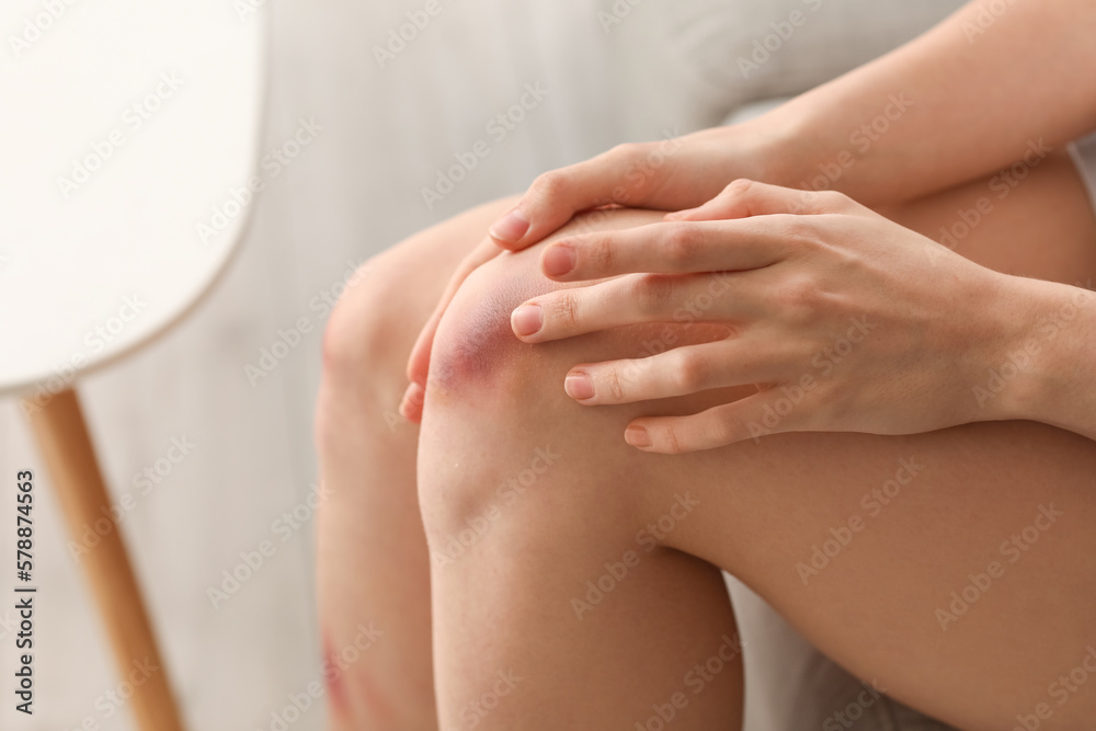 Young woman with bruised knee sitting on sofa at home, closeup Young woman with bruised knee sitting on sofa at home, closeup