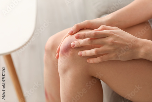 Young woman with bruised knee sitting on sofa at home  closeup