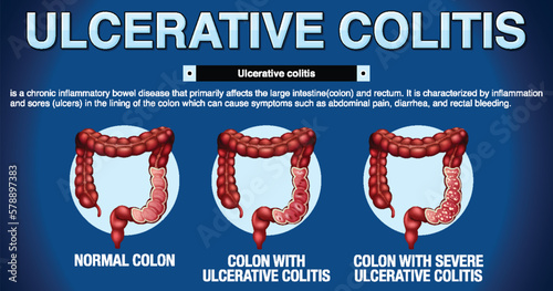 Ulcerative Colitis Symptoms Infographic