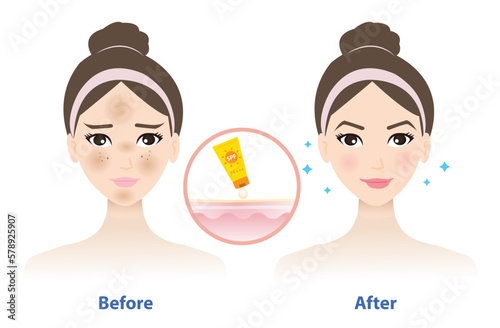 Before and after get used sunscreen vector isolated on white background. Comparison of woman face with melasma and the better result of wearing sunscreen on face. Skin care and beauty concept.