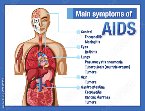 Informative poster of main symtoms of AIDS photo