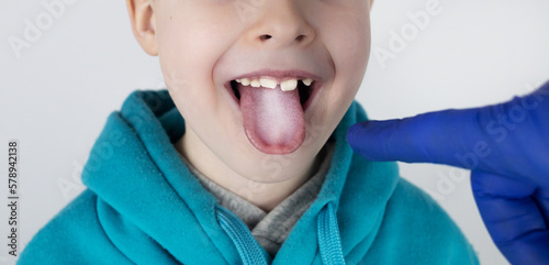 Blond boy has a white tongue. Painful white coating on the mucous membrane of the tongue. Diseases of the gastrointestinal tract, liver and gallbladder. The consequences of taking antibiotics. photo