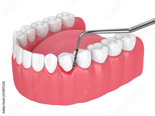 3d render of human jaw with peri implantitis disease and periodontal sonda