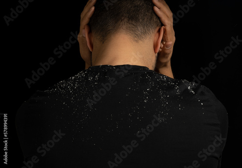 Close up low key portrait of man with dandruff or itchy hair problem. Concept of hair care,  dandruff and seborrheic dermatitis. photo