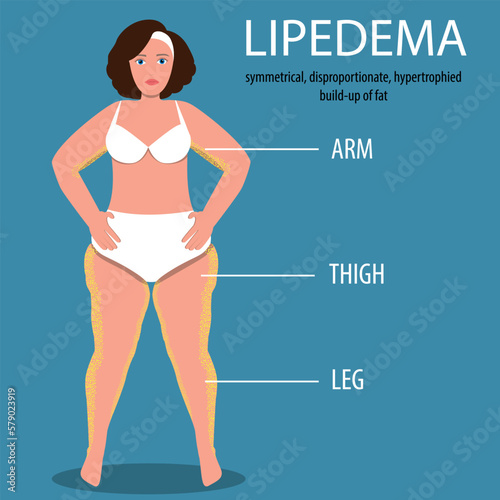 Lipedema awareness concept. Overweight woman with lipedema fat increase