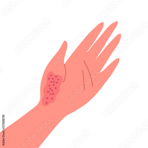 Dermatitis on the skin of a human hand. Dermatological disease. The symptom is itching, pain, redness and rash. Allergic reaction. Medical diagnostics and treatment. Vector illustration