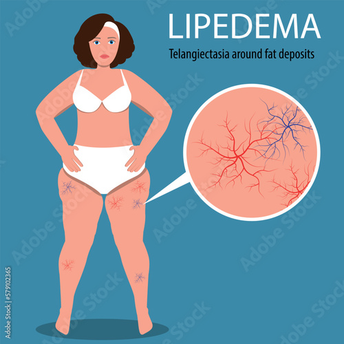 Lipedema and Telangiectasia Awareness Concept. Illustration of overweight woman with lipedema and spider veins photo