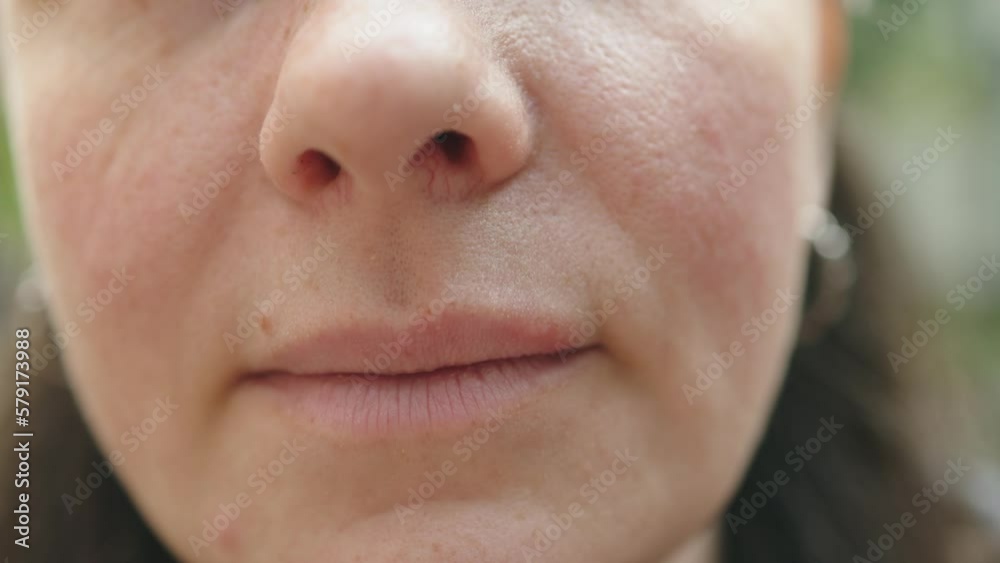 closeup herpes sores on upper lip female face. herpes simplex pimples