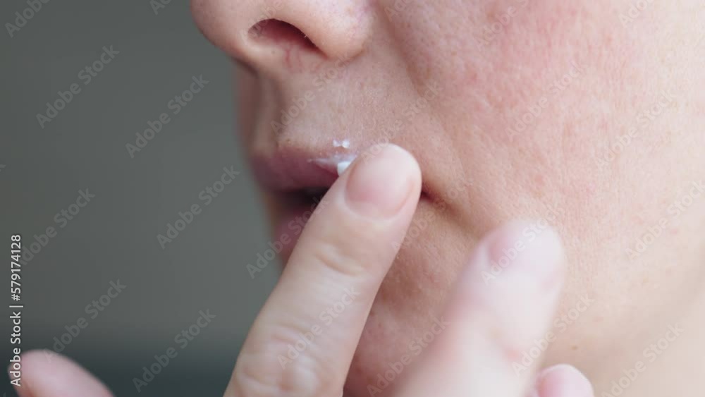 applying ointment on herpes simplex pusfilled blisters bumps. female