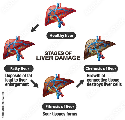 Stages of Liver Damage Infographic
