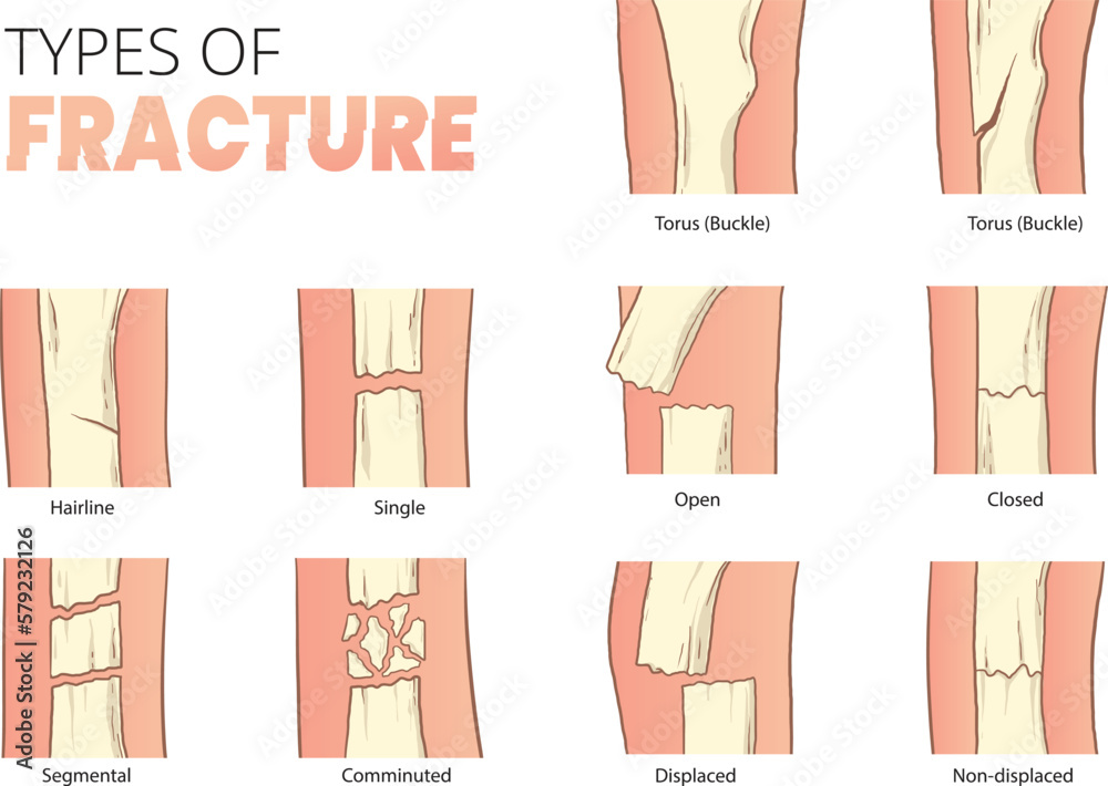 Types Of Bones Fracture Stock Vector Adobe Stock