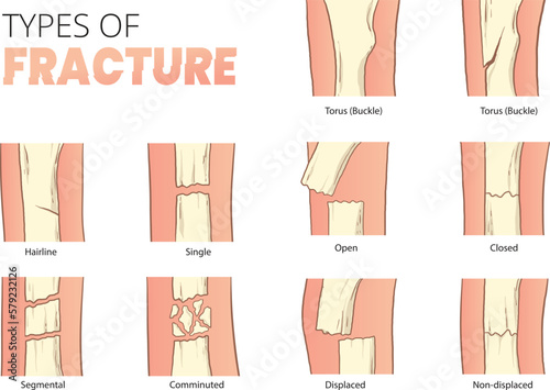 types of bones fracture