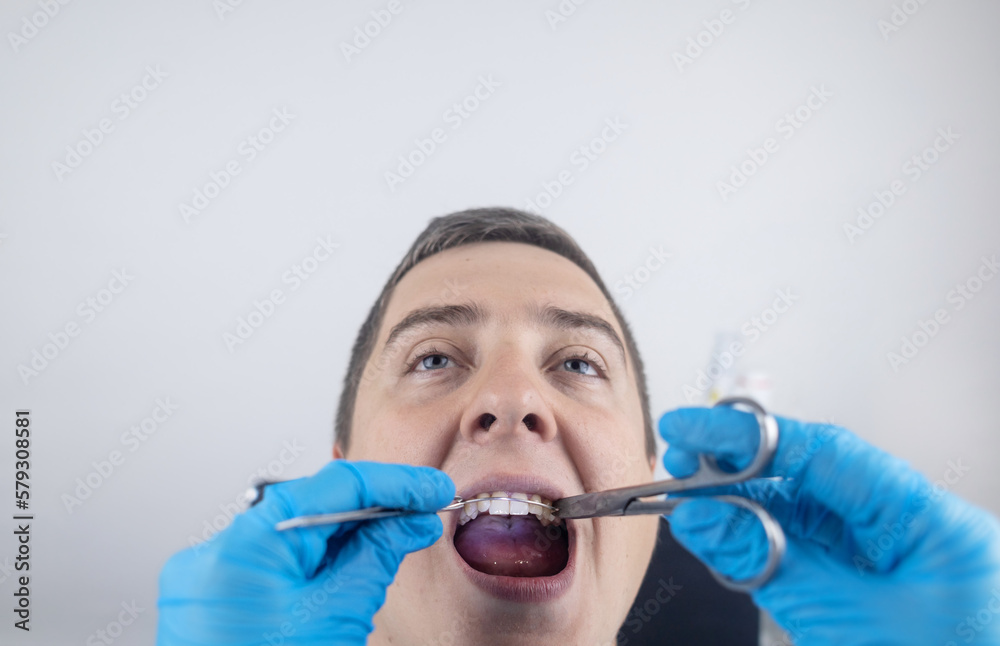 Installation of braces, bridges and a dental plate to correct teeth. An orthodontist installs a bracket system on an uneven jaw. Implants and smile correction. Concept of working in the dentist office Installation of braces, bridges and a dental plate to correct teeth. An orthodontist installs a bracket system on an uneven jaw. Implants and smile correction. Concept of working in the dentist office