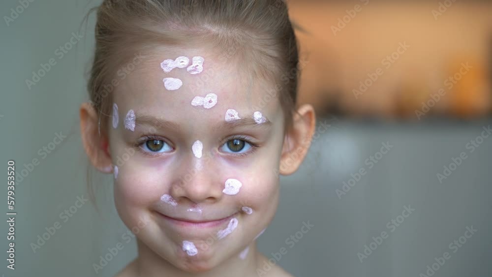 Close up of sick little girl with ointment on face of with chickenpox