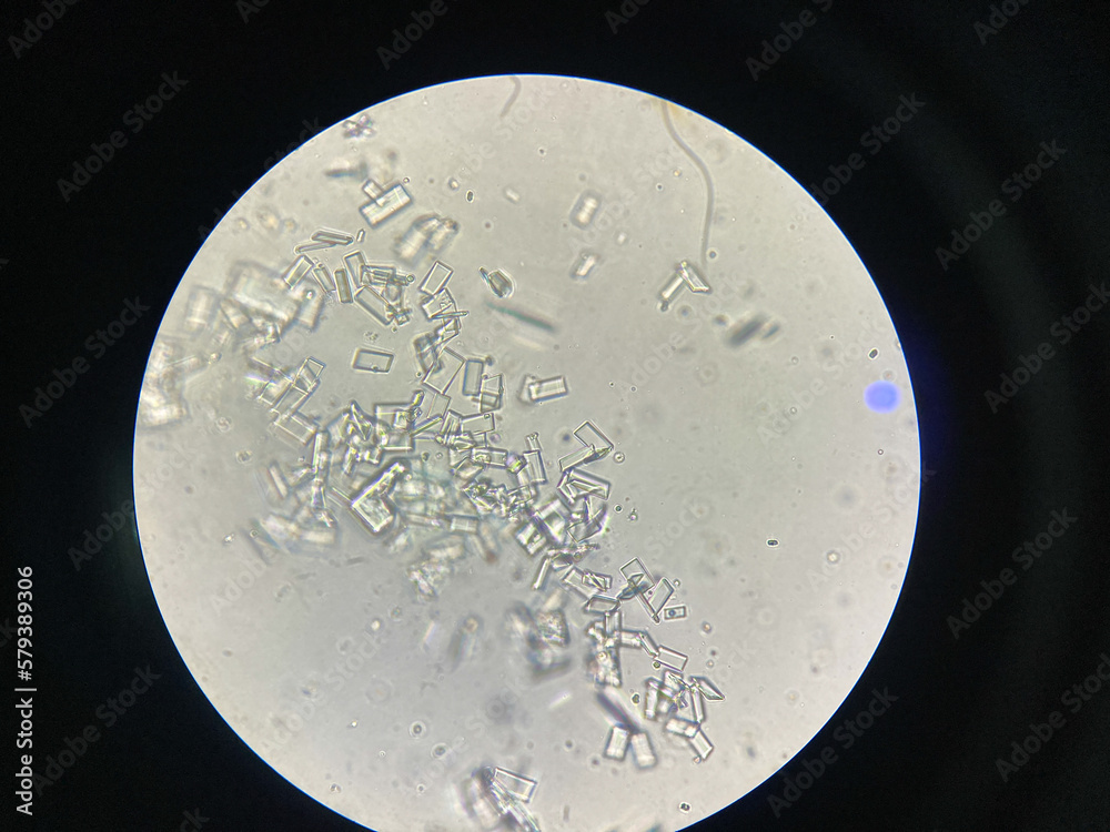 Urine Sediment Exam Struvite Crystals With Pus Cells And 8356