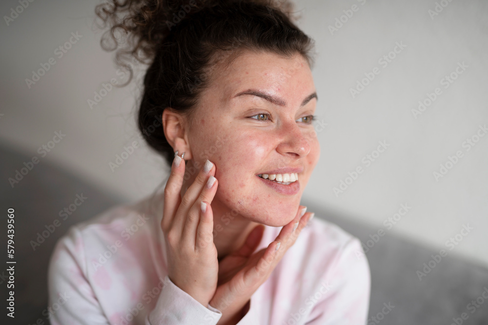 Young beautiful woman with problem skin, acne, doing home cosmetic care Young beautiful woman with problem skin, acne, doing home cosmetic care