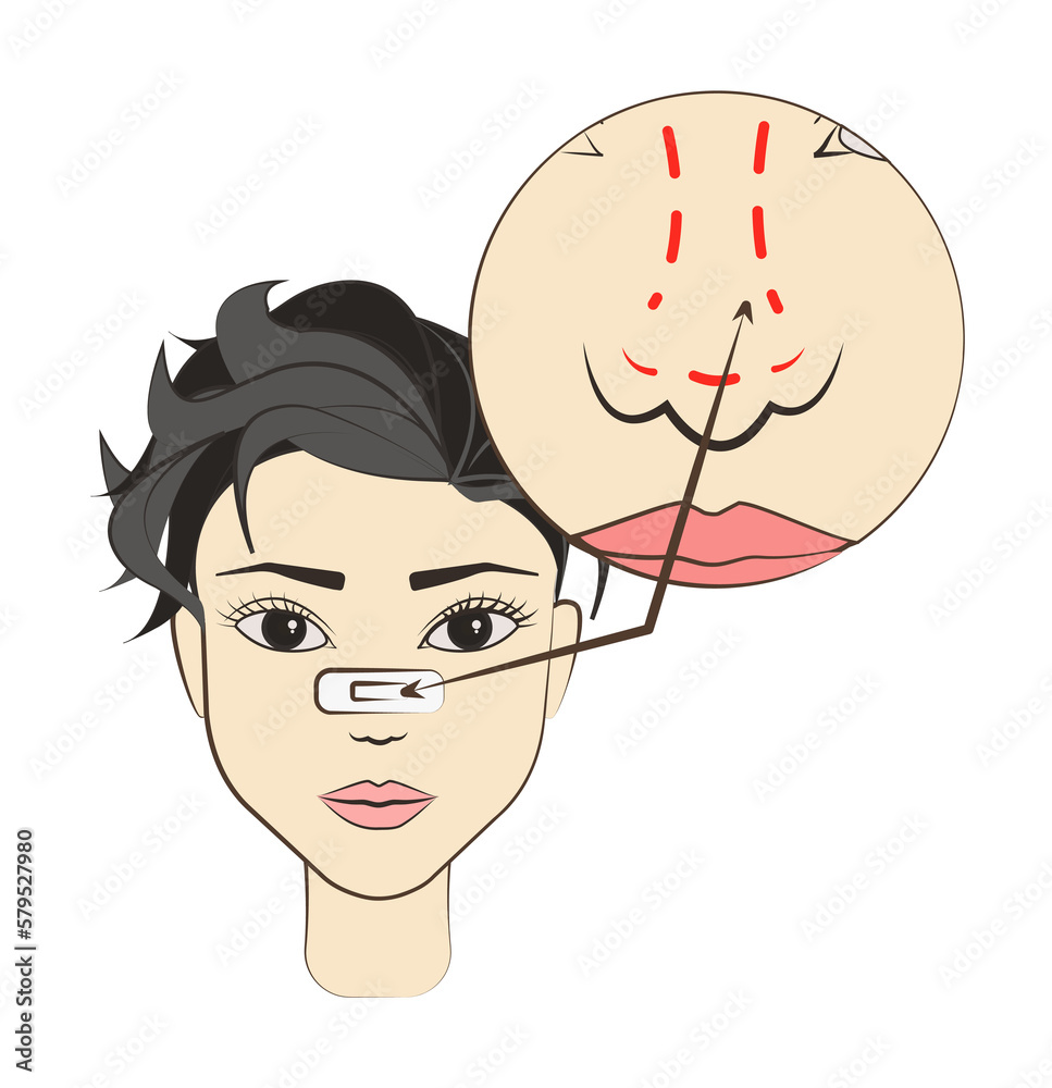 Obraz na plátně surgery correcting nose colored icon