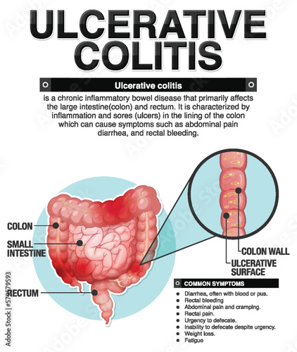 Ulcerative Colitis Symptoms Infographic
