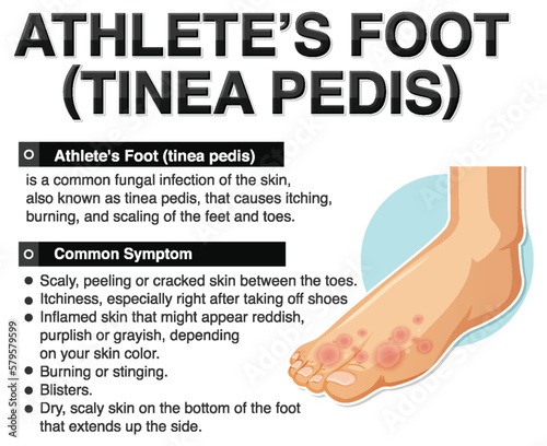 Informative poster of Athlete foot
