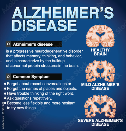 Informative poster of Alzheimers disease