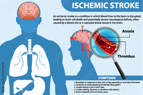 Informative poster of Ischemic stroke