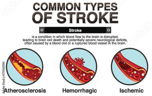 Informative poster of common types of stoke