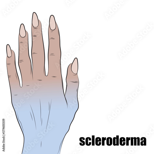 Scleroderma, a chronic disease of women, makes the skin thick, causes inflammation in different areas of the body and hardens.