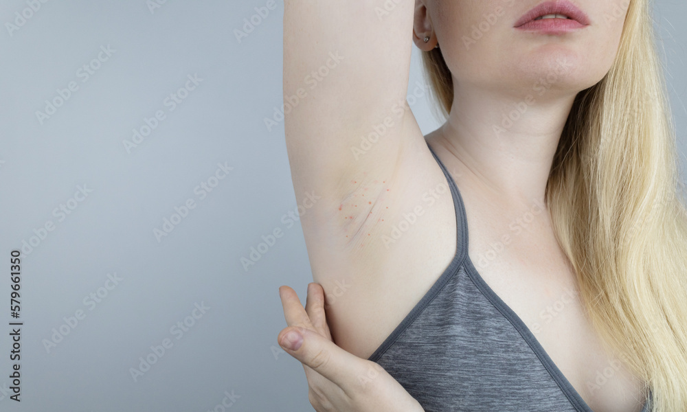 Armpit rash. Underarm skin irritation. Blonde girl shows irritation on