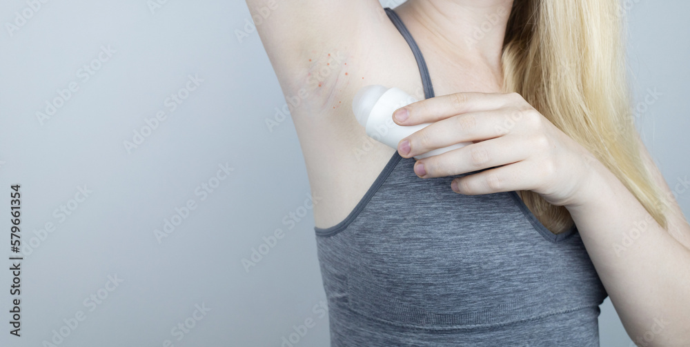 Armpit rash. Underarm skin irritation. Blonde girl shows irritation on