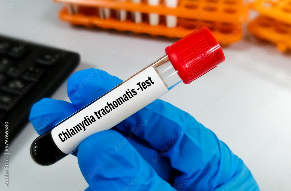 Naklejka premium Blood sample with Chlamydia trachomatis test order. STD, STI