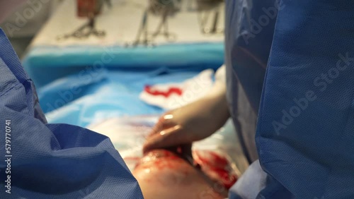 The process of removing a baby from the uterus by caesarean section. Caesarean section operation close-up. Variable focus. High quality 4k footage