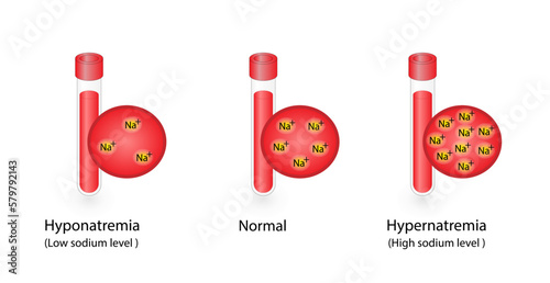 Hypernatremia, high plasma sodium level and Hyponatremia, low plasma sodium level. Sodium Na excess and deficit electrolyte disorders, blood test tube, Scientific design. Vector illustration.