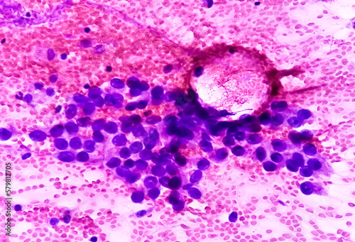 Photomicrograph of fine needle aspiration (FNA) cytology of a pulmonary (lung) nodule showing adenocarcinoma, a type of non small cell carcinoma. photo