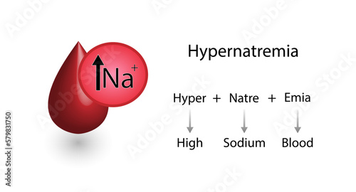 Hypernatremia, high plasma sodium level and Hyponatremia, low plasma sodium level. Sodium Na excess and deficit electrolyte disorders, blood test tube, Scientific design. Vector illustration.