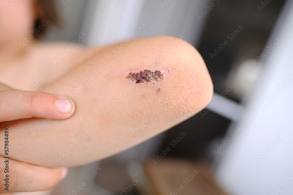 healing wound on child's hand, crusted abrasion in elbow area, scar, traumatic safety concept