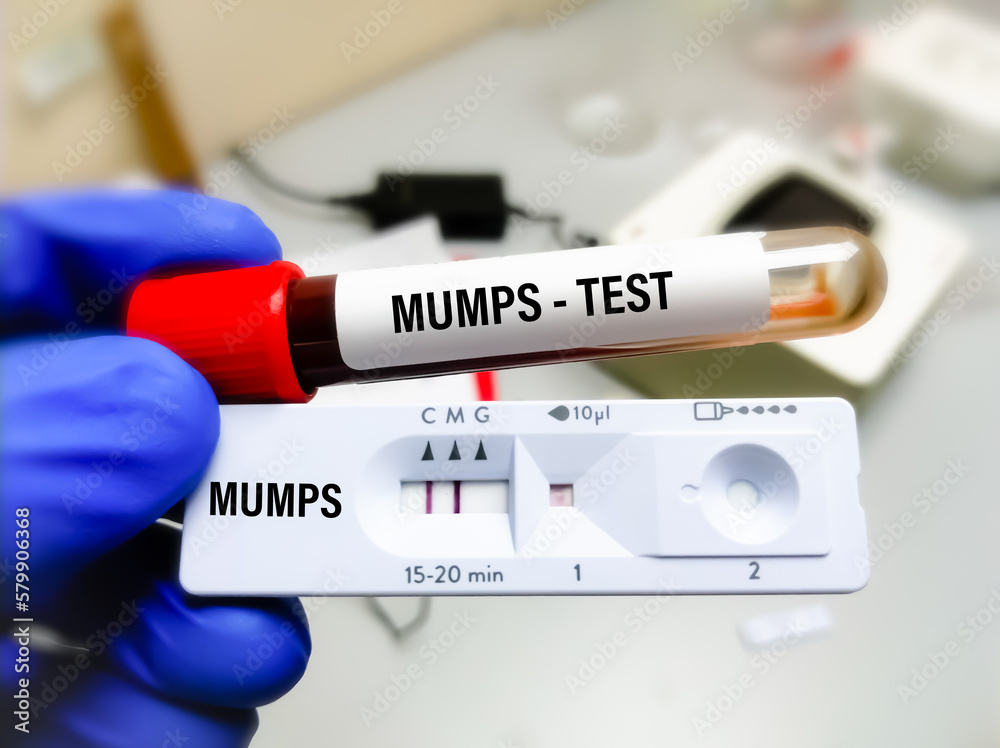 Mumps Test, blood sample and rapid test cassette in infection lab